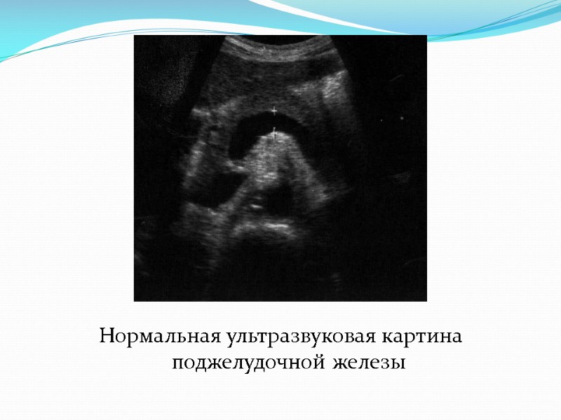 Нормальная ультразвуковая картина поджелудочной железы